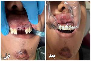 نجات دندان‌های نوجوان ۱۵ ساله با اقدام به‌موقع دندانپزشک نوجین